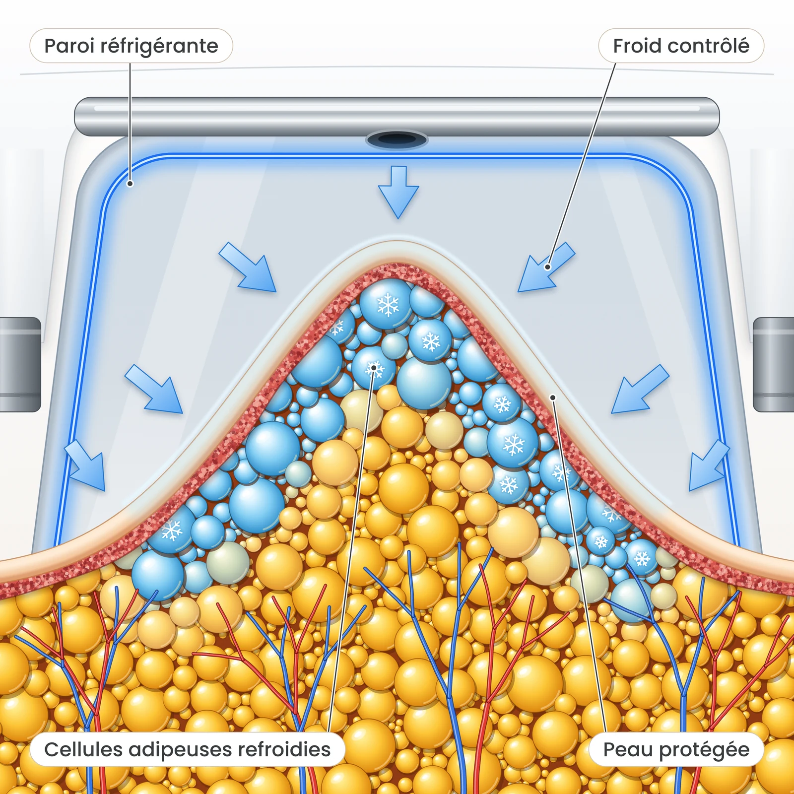 Étape 2 de la cryolipolyse : refroidissement contrôlé de l’amas graisseux et cristallisation des lipides dans les cellules adipeuses.