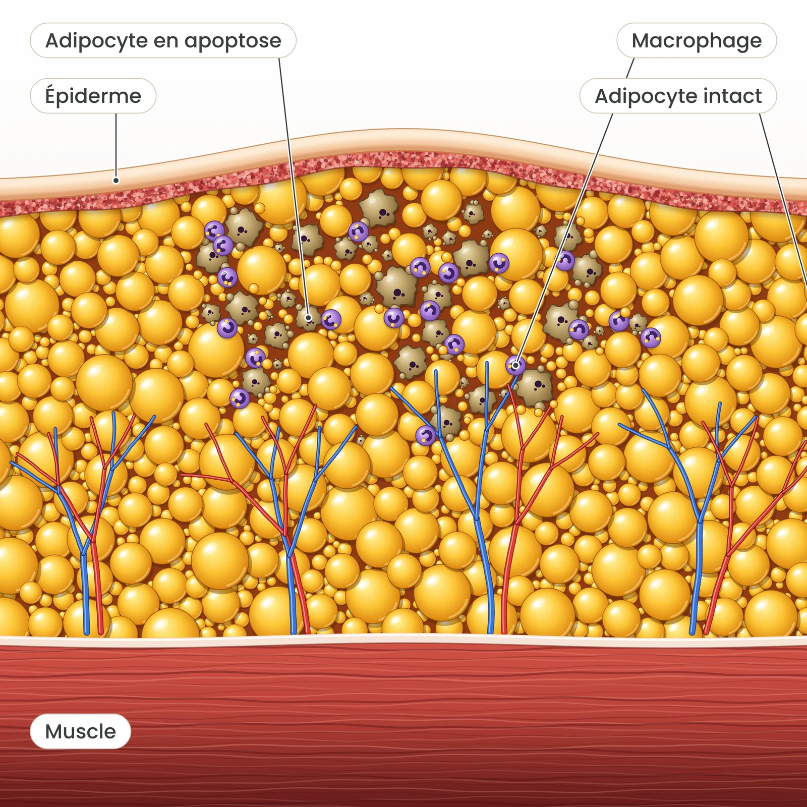Étape 3 de la cryolipolyse : apoptose progressive des cellules adipeuses traitées et intervention des macrophages.